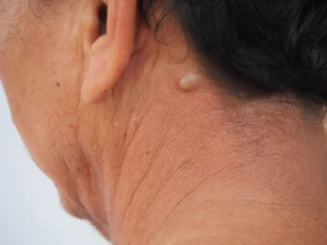 Khối U Nhỏ: Cảnh Báo Của Cuộc Sống