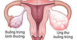 Những Dấu Hiệu Cảnh Báo Ung Thư Buồng Trứng Phụ Nữ Nên Biết